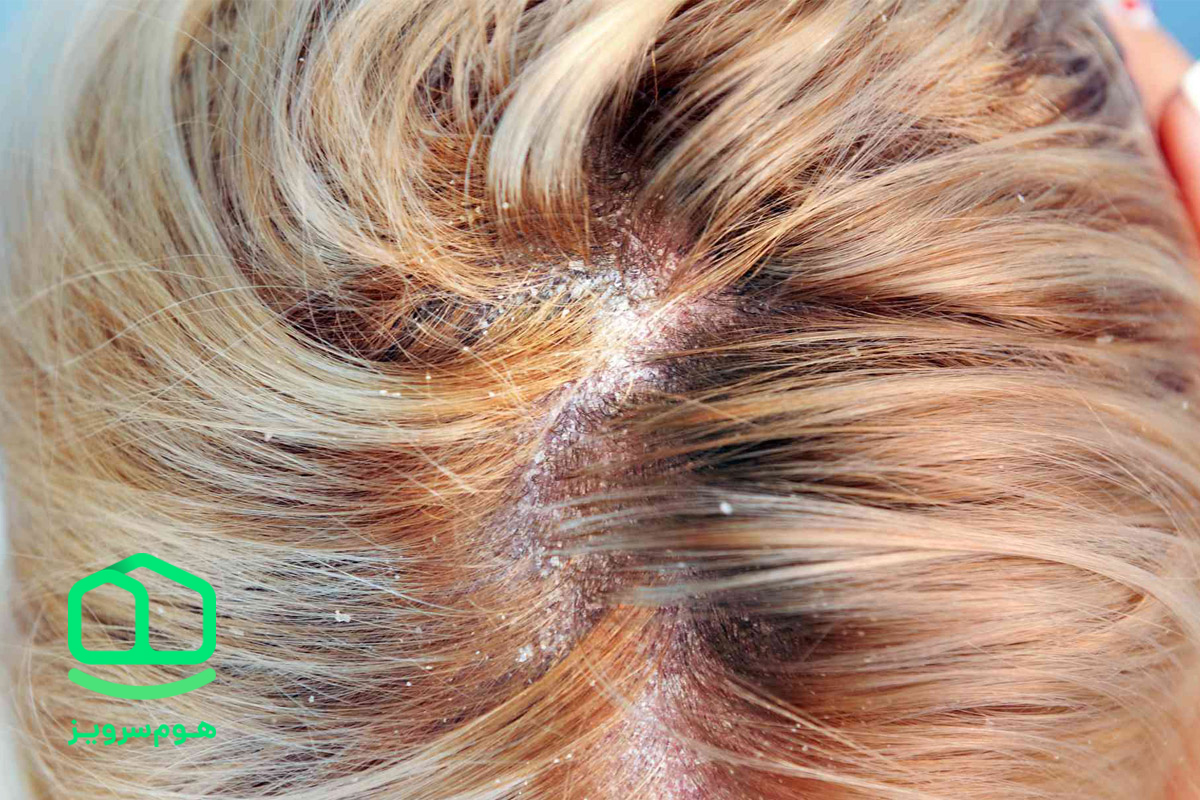 مبارزه با شوره؛ یک تأثیر روغن جوجوبا برای مو