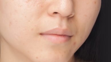 چند راهکار مفید و کاربردی برای درمان لک های پوستی