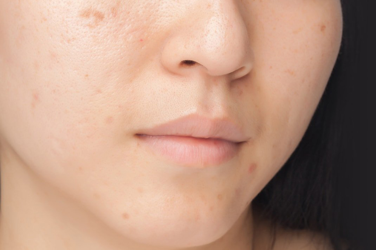 چند راهکار مفید و کاربردی برای درمان لک های پوستی