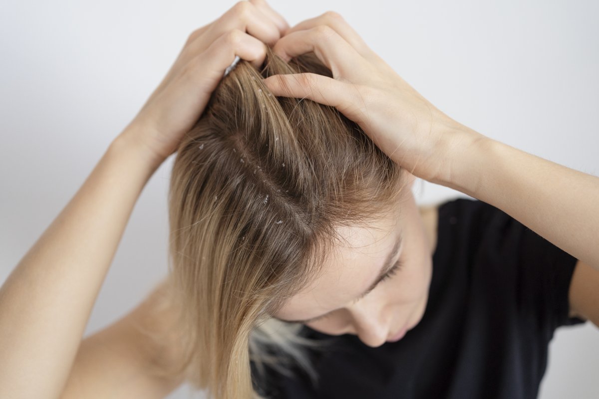 درمان خانگی خارش موی سر