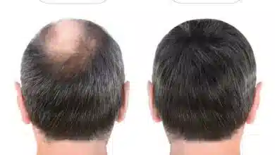 اسکالپ سر چیست
