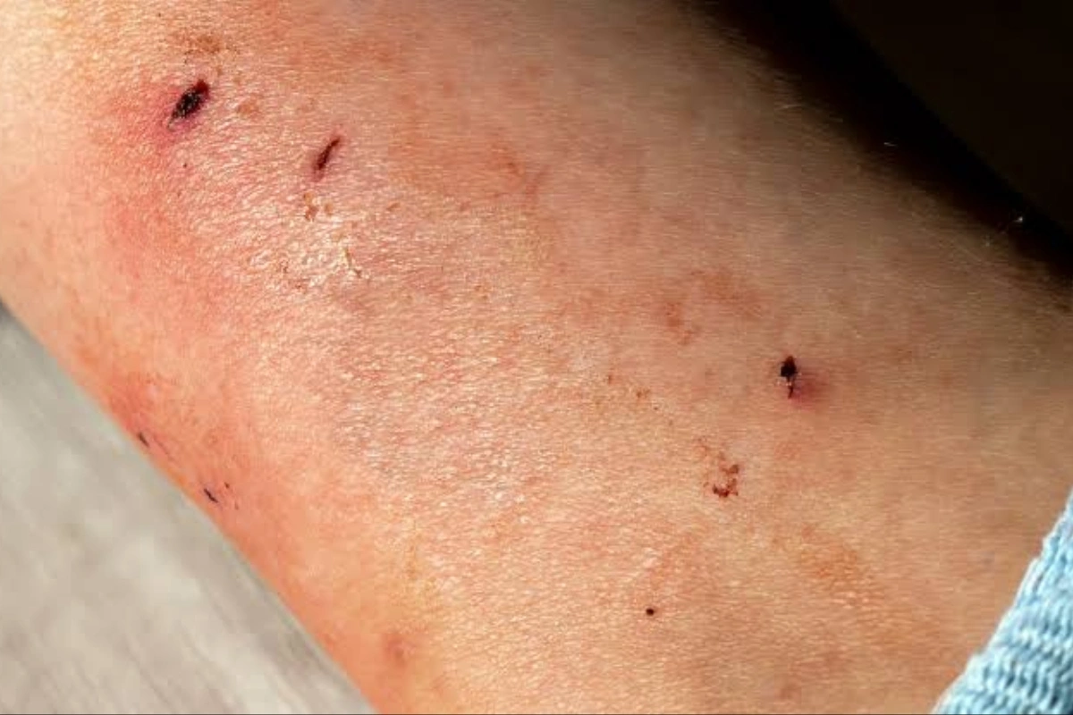 بعد از گاز گرفتن گربه چه کنیم؟