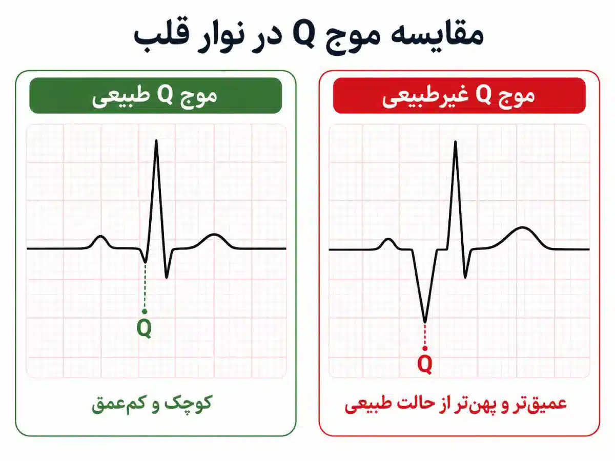 تفسیر نوار قلب برای پرستاران