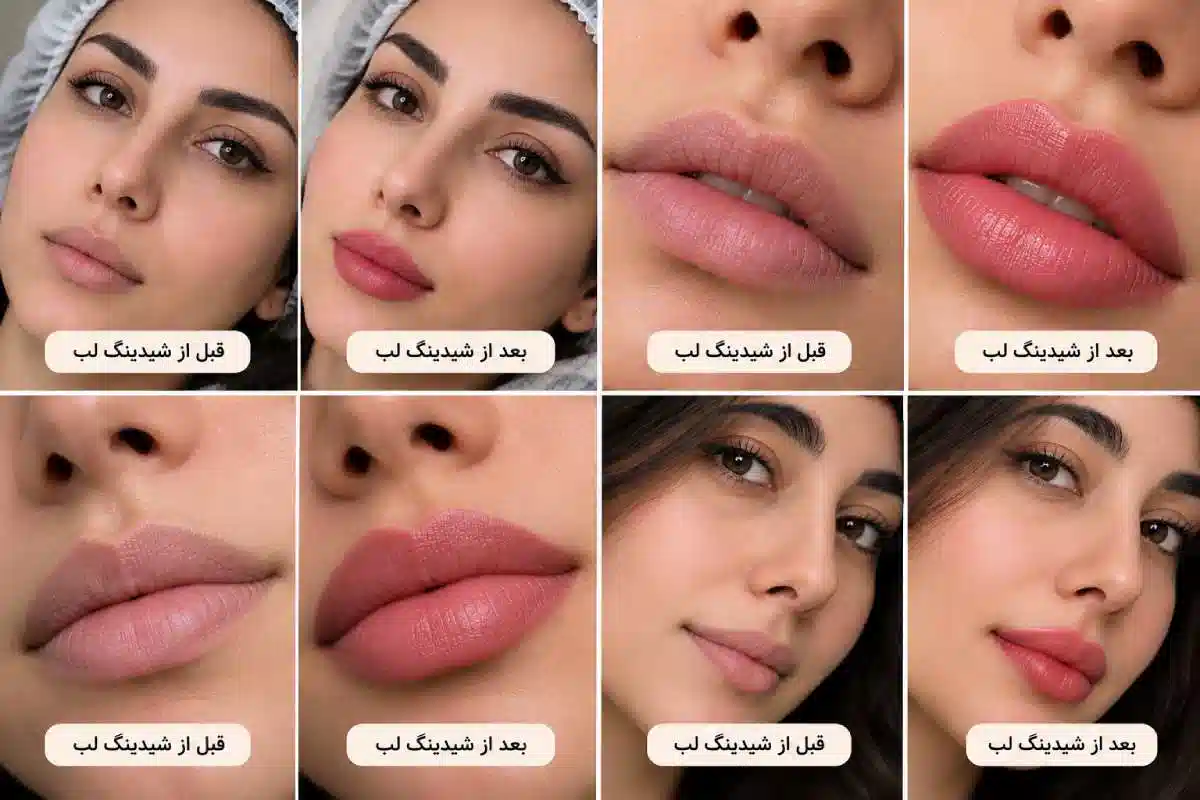 عکس قبل و بعد از شیدینگ لب