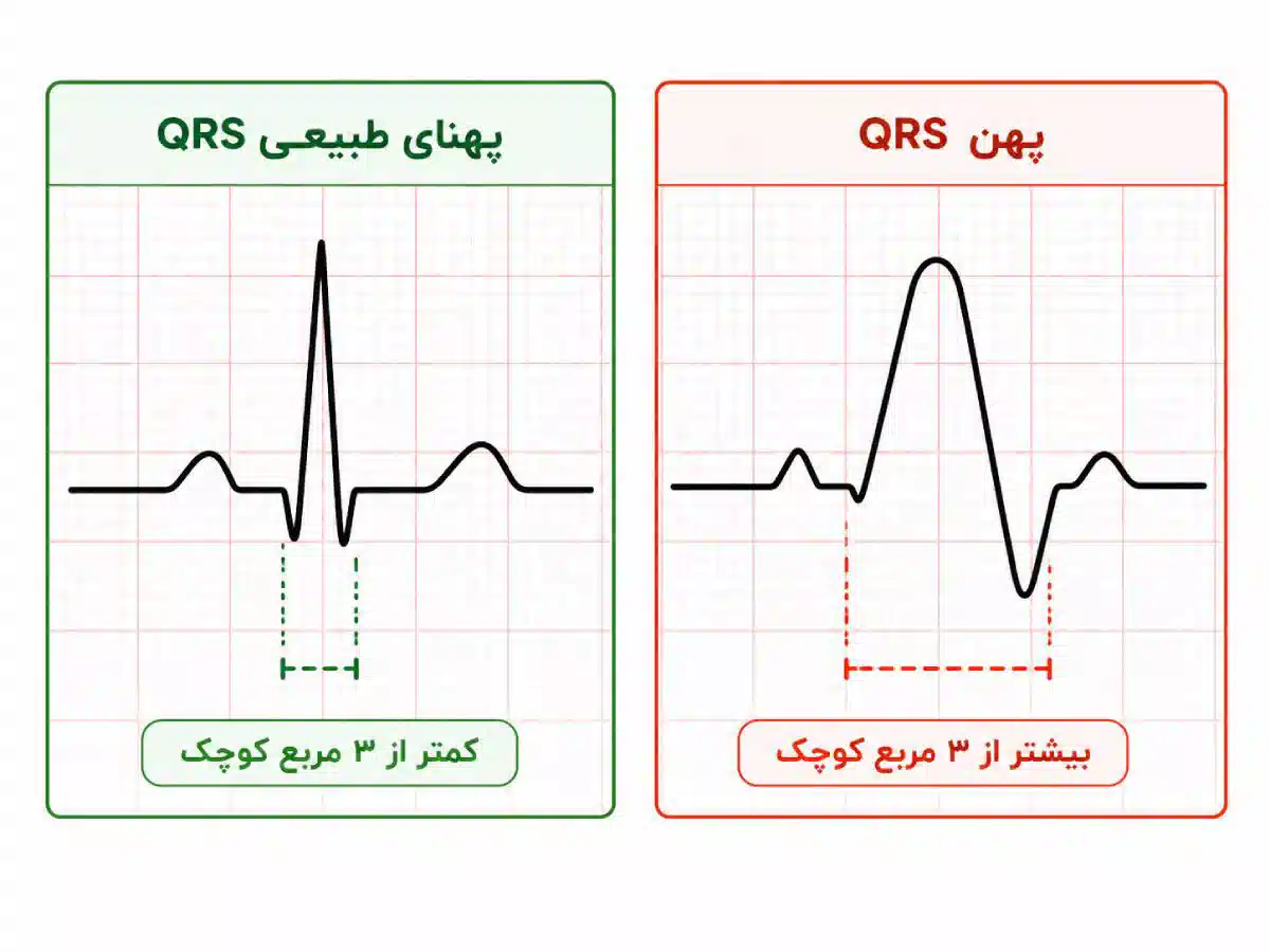موج QRS در نوار قلب