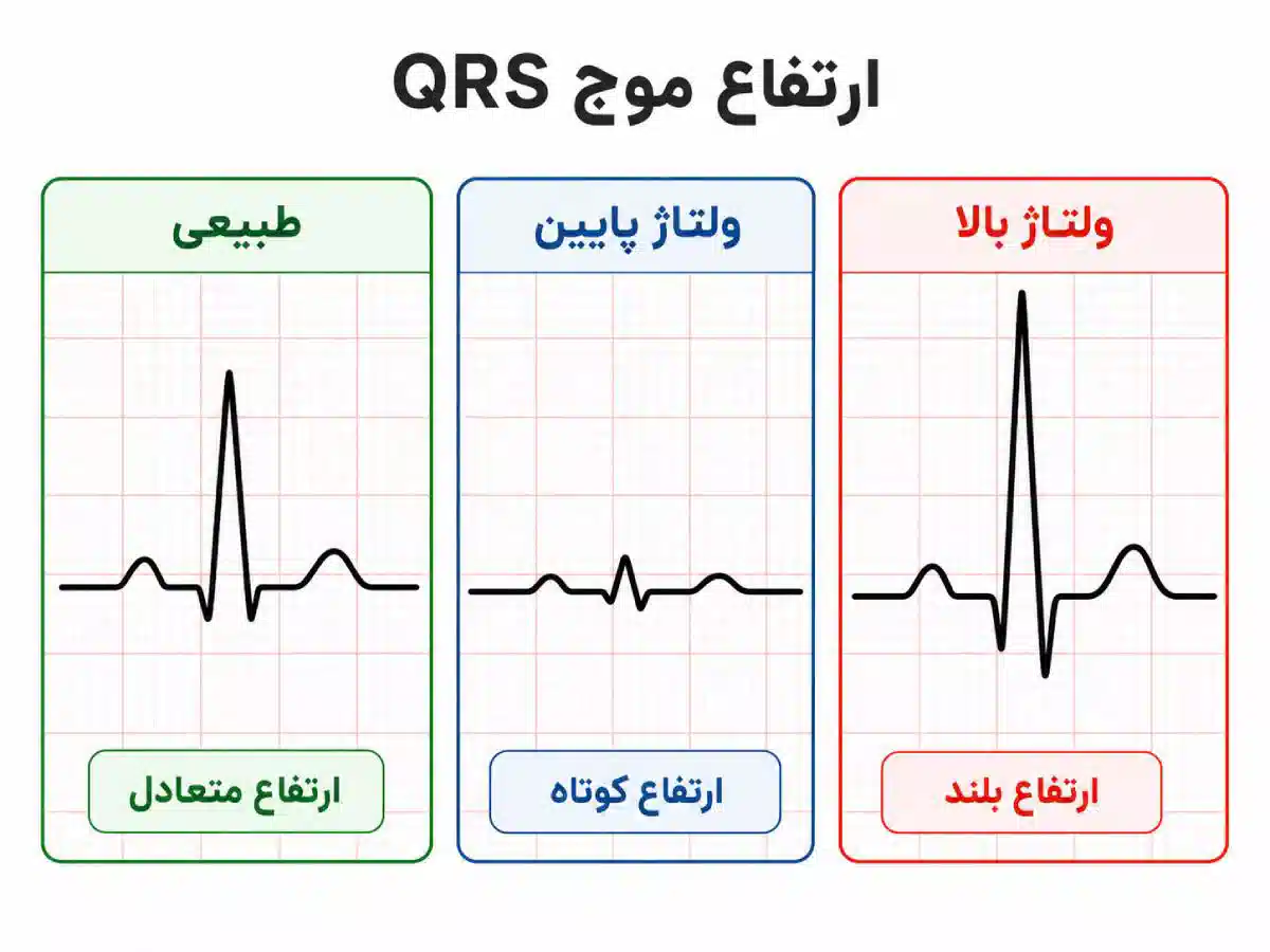 موج QRS در نوار قلب کجاست؟